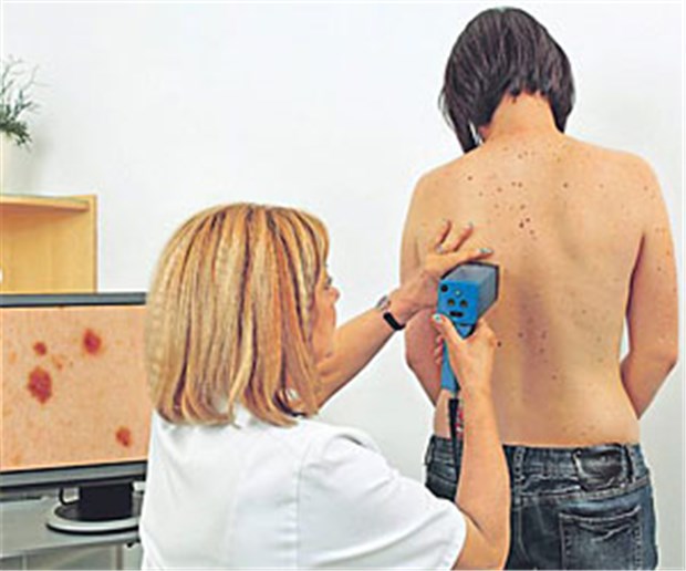 Licht im Dunkeln bei schwarzem Hautkrebs Ärztin beim Naevi-Check: Auch bei Melanom-Metastasen steigen mit den neuen Substanzen die Therapiechancen.