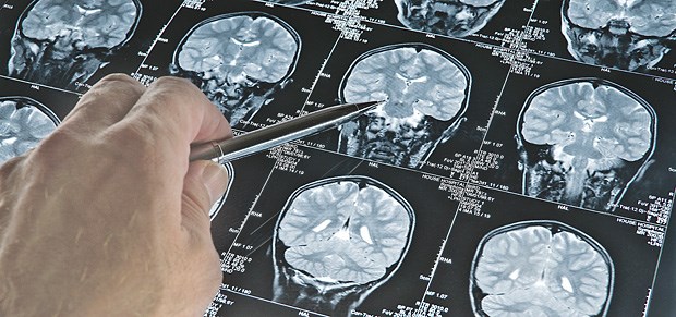 Ist bei Alzheimer das Gefäßwachstum außer Kontrolle? Alzheimer-Ursache: Zuerst sprießende Endothelzellen in den Hirngefäßen, dann die Plaques?