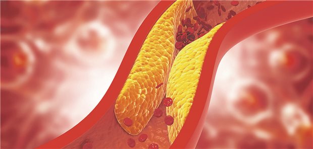 Lipoprotein(a) erhöht bei Statin-Therapie: Wie steht es um das kardiovaskuläre Risiko? Stenose in einem Blutgefäß.