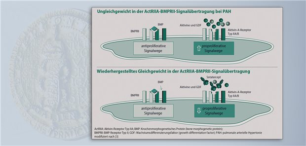 Winrevair® – Erster Aktivin-Signalweg-Inhibitor bei pulmonaler arterieller Hypertonie Bei PAH überwiegen proproliferative und antiapoptotische Signalwege. Sotatercept reduziert die Aktivierung des Aktivin-Signalwegs und stellt das Gleichgewicht mit antiproliferativen und proapoptotischen Effekten wieder her.  MSD Sharp & Dohme GmbH