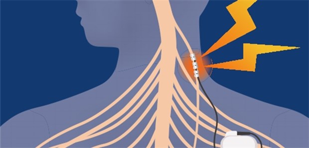 Vagus-Nerv-Stimulation lindert Depressionen langfristig Bei der VNS wird der linke Nervus vagus elektrisch stimuliert. Der Impulsgeber wird subkutan in der Schlüsselbeinregion implantiert.