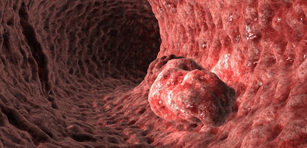 Darmkrebs: DNA-Test punktet beim Screening Darmkrebs-Vorstufe Polyp in der Koloskopie. Ein neuer DNA-Test besticht durch seine Nicht-Invasivität und eine hohe Sensitivität.