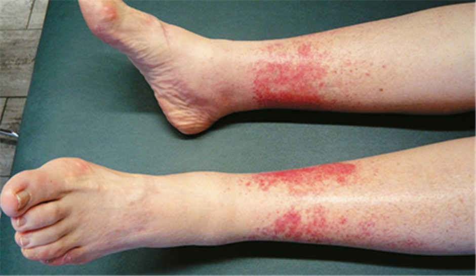 Purpura d'effort des Läufers rote Beine bei großer Hitze
