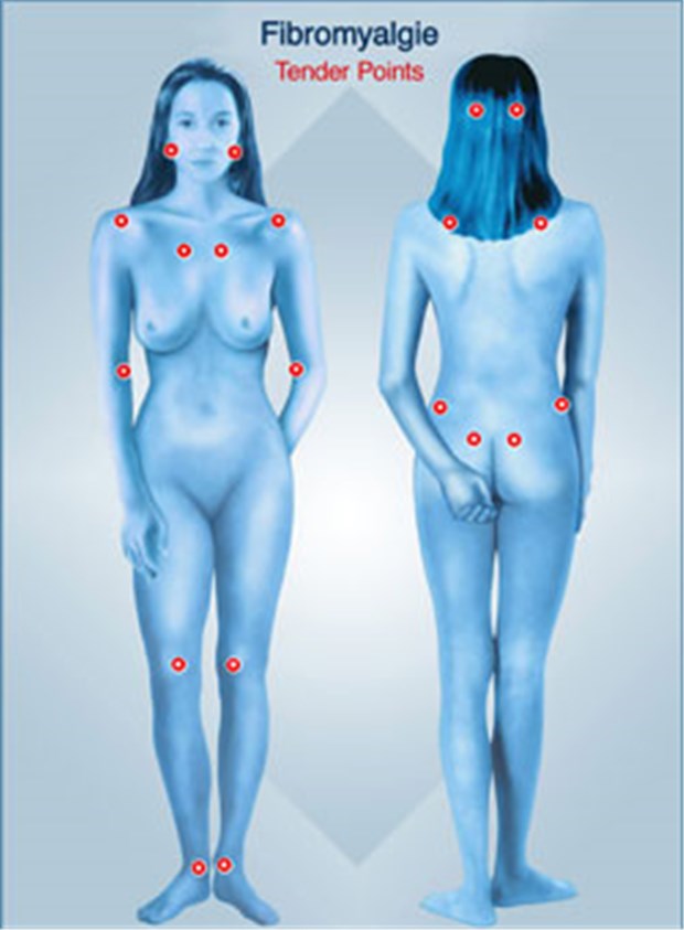 Ins Dunkel kommt etwas Licht Druckschmerzpunkte bei Fibromyalgie.