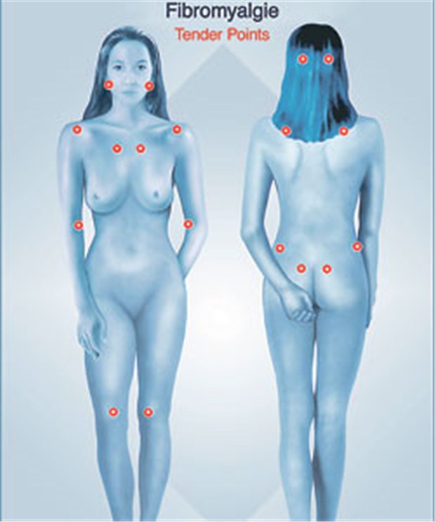 Zwischen Stimulation und Verarbeitung von Reizen stimmt etwas nicht Druckschmerzpunkte bei Fibromyalgie.