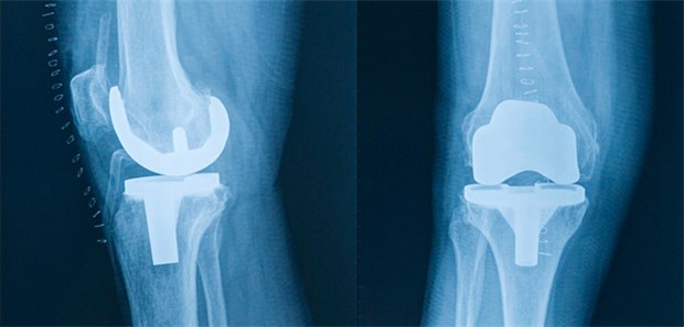 Knie-Op bringt Verbesserungen Ein Knieersatz kann helfen, die eingeschränkte Lebensführung wieder zu erleichtern.
