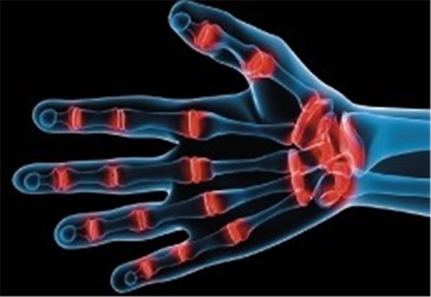 TNF-α-Hemmer bremst früh radiologische Progression Entzündete Gelenke der Hand bei Rheumatoider Arthritis.