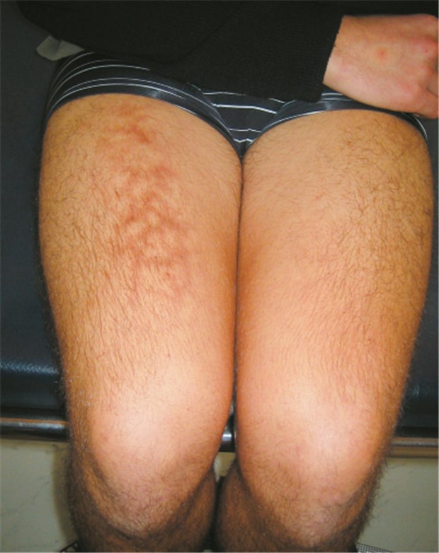 Laptop auf dem Schoß - mit Nebenwirkungen Erythema ab igne durch einen Laptop: Typisch ist die netzartige Hautzeichnung auf den Oberschenkeln. © Claude Bachmeyer/Service de Médecine Interne, CHU Tenon, Paris