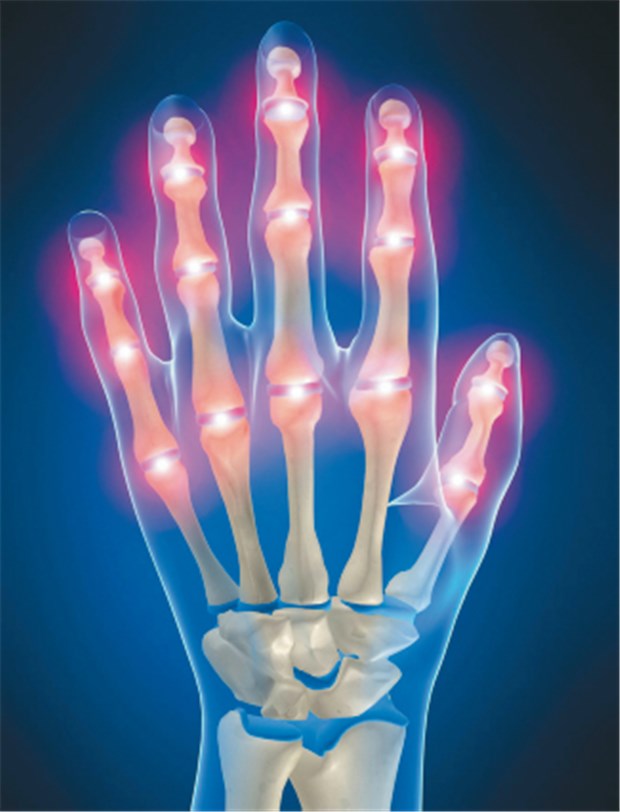 Frühzeitig Arthrose - hier lohnt der Blick auf Ferritin Fingergelenkschmerzen sind ein Hämochromatose-Warnsignal. © S. Kaulitzki / fotolia.com