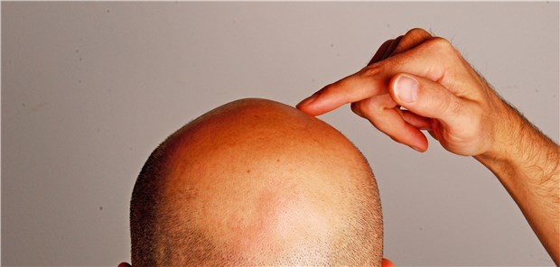 Depressionen durch Haarwuchsmittel? Haarwuchsmittel in der Kritik: Wie sehr fördert ein darin enthaltener Wirkstoff möglicherweise Depressionen und Libidostörungen?
