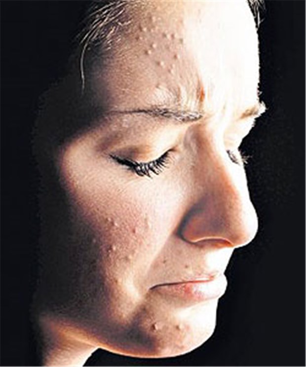 Psychische Komponente überfordert viele Dermatologen Hautkrankheiten wie zum Beispiel eine Akne können enorm auf der Psyche lasten.