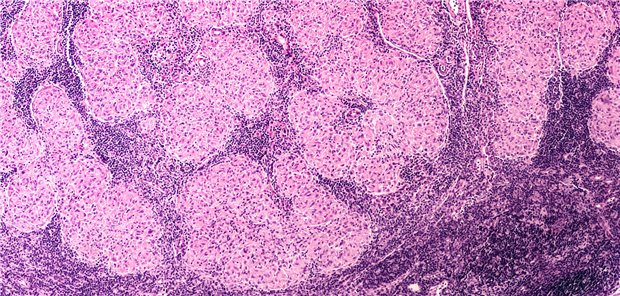 Histologischer Schnitt in HE-Färbung eines Lymphknotens einer Patientin mit dem typischen Bild einer nicht-nekrotisierenden granulomatösen Entzündung, wie sie bei einer Sarkoidose vorkommen kann.