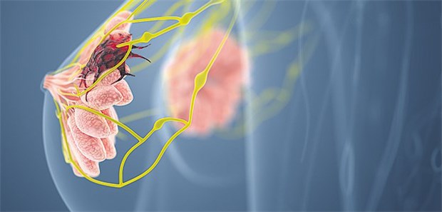 Erweiterte Bestrahlung senkt Rezidivrisiko In der Studie mit Brustkrebs-Patientinnen wurden klare Vorteile der erweiterten Bestrahlungsstrategie nach zehn Jahren festgestellt.