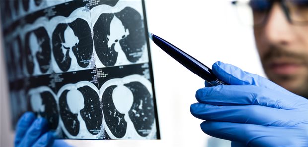 Kritischer Blick auf die CT-Bilder der Lunge. Ein strukturiertes Früherkennungsprogramm für Lungenkrebs würde sich auf die mit LDCT generierten Bilder stützen.