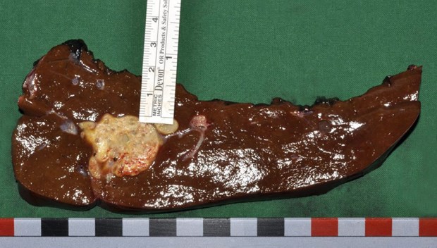 Fuchsbandwurm - der Schrecken im Dünndarm Leber mit alveolärer Echinokokkose. Feine Bläschen wuchern wie ein maligner Tumor.