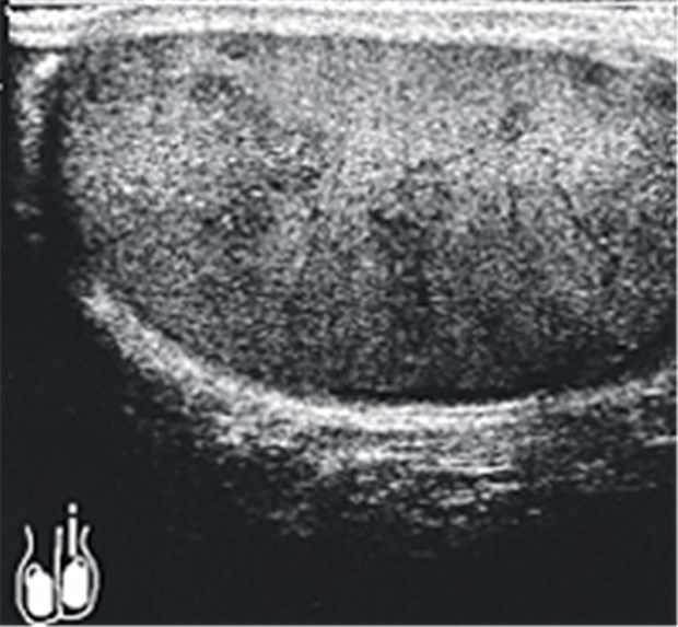 Hodenschmerzen: Ursache war eine Zoonose Mit Ultraschall ergab sich eine unruhige, unspezifische Morphologie mit angedeutetem "Sternenhimmelbild" des linken Hodens bei blandem Befund.