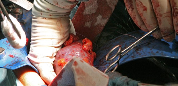 Große Aufregung um einen 'alten Hut'? Nierenentnahme: Wo geht die Reise bei der Transplantatqualität in Deutschland hin?