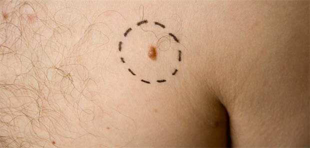 Apps für eine erste Einschätzung geeignet Per App können auffällige Pigmemtmale ausfindig gemacht werden, zeigt die Studie. Die ärztliche Diagnose kann sie nicht ersetzen.