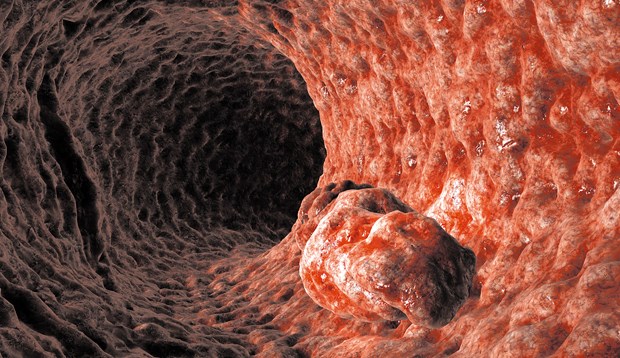 Polypen sind Darmkrebs-Vorstufen: Der Krebs ist in Ländern mit hohem Rindfleischkonsum besonders häufig.