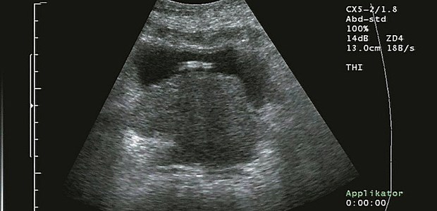 Androgenentzug bringt keine Zweittumoren Prostata-Ca im Schall.
