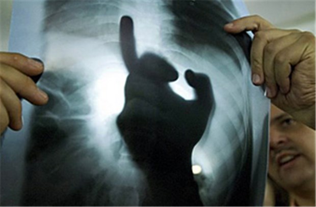 WHO mahnt sorgfältigen Umgang mit Antibiotika an Röntgenbild bei Tuberkulose-Verdacht: resistente Keime nehmen zu.