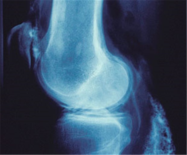 Psoriasis-Arthritis wird oft übersehen Rupturierte Baker-Zyste (rechtes Kniegelenk) bei Psoriasis-Arthritis.