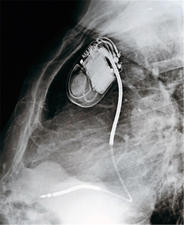 Intelligente Implantate als Therapiebetreuer Seit mehr als 50 Jahren geben Schrittmacher Herzen den Takt vor. Die Entwicklung bei Implantaten ist seither rasant verlaufen.