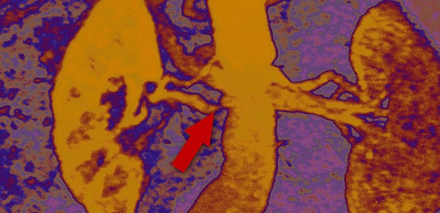 Stenting wirkt nicht präventiv Stenose kurz vor der Niere: Stents konnten sich in der CORAL-Studie nicht behaupten.