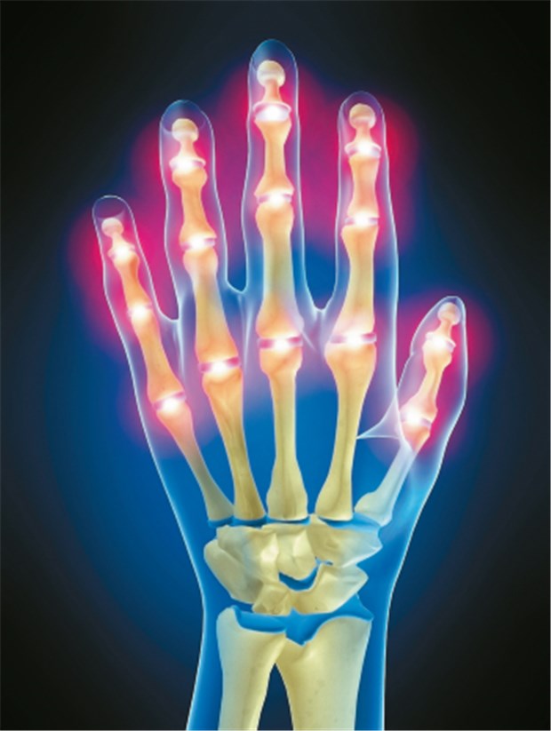 Frühe Diagnose und Therapie - das bremst die Gelenkschäden Symbolische Darstellung von entzündeten Gelenken der Hand, von denen die Schmerzen ausgehen.