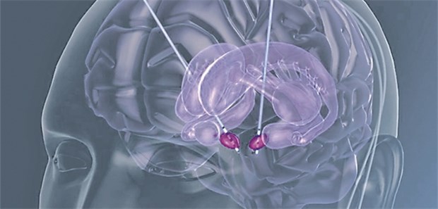 Tiefe Hirnstimulation schaltet Anorexie ab Tiefe Hirnstimulation: Die Implantation der Elektroden verlief bei fast allen Studienteilnehmerinnen ohne größere Komplikationen.