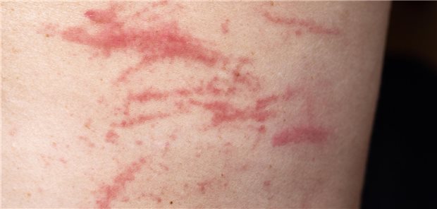 Typische Kratzexkoriationen bei juckender Haut und Gefühl des Ameisenlaufens.