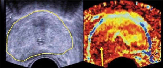 Mehr Prostata-Karzinome diagnostiziert Ultraschall bei einem Prostata-Karzinom (links). Mit Elastografie (rechts) ist der Tumor als dunkle Region zu sehen.