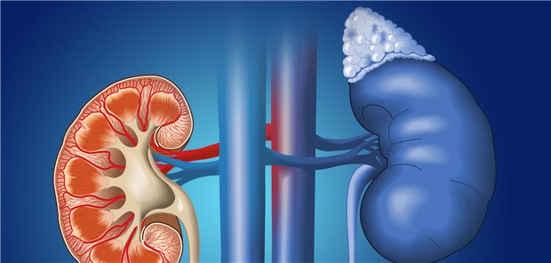 Vereinfachte Darstellung der Nieren und Nebenniere. Eine Nebenniereninsuffizienz tritt mit dem Alter häufiger auf.