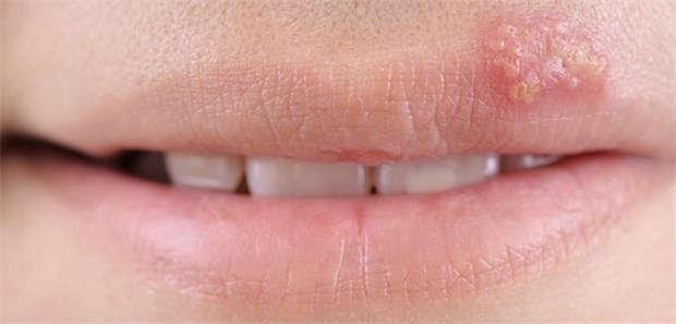 Herpes und der Alzheimer-Verdacht Von den Alzheimerpatienten zeigten knapp 94 Prozent IgG-Antikörper gegen HSV-1.