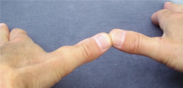 Chronischer Druck verursachte münzgroßen subkutanen Tumor Wind von links ... und ein Tumor am Daumen des Windsurfers.
