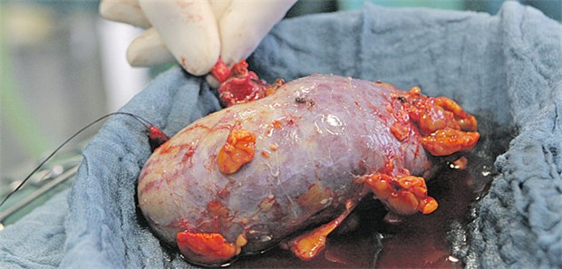Auch geschädigte Nieren zur Transplantation geeignet Zur Transplantation vorgesehene Spenderniere. Die Ausschlusskriterien für Organe sind offenbar zu eng.