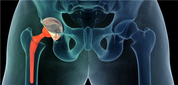  Hüftendoprothese: Relevante Punkte zur Indikation für die Op sind in einer neuen Leitlinie zusammengestellt worden.