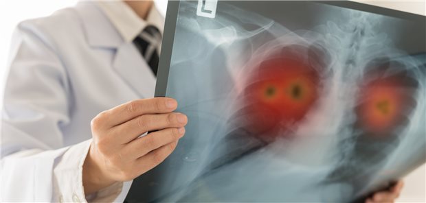  Lungen-Karzinom: Es lohnt sich einer aktuellen Studie zufolge nicht, bei fortgeschrittenem oder metastasiertem nicht-kleinzelligem Lungen-Karzinom länger als zwei Jahre mit einem Checkpoint-Hemmer zu behandeln. 