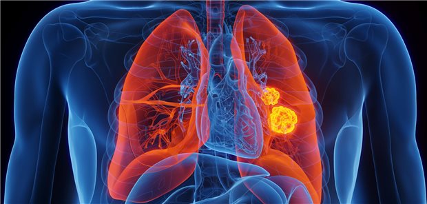  Lungenkarzinom im Visier: 81 Prozent von 1257 Teilnehmerinnen und Teilnehmern, deren Bronchialkarzinome im Rahmen des Screening-Programms entdeckt wurden, lebten auch noch nach 20 Jahren.