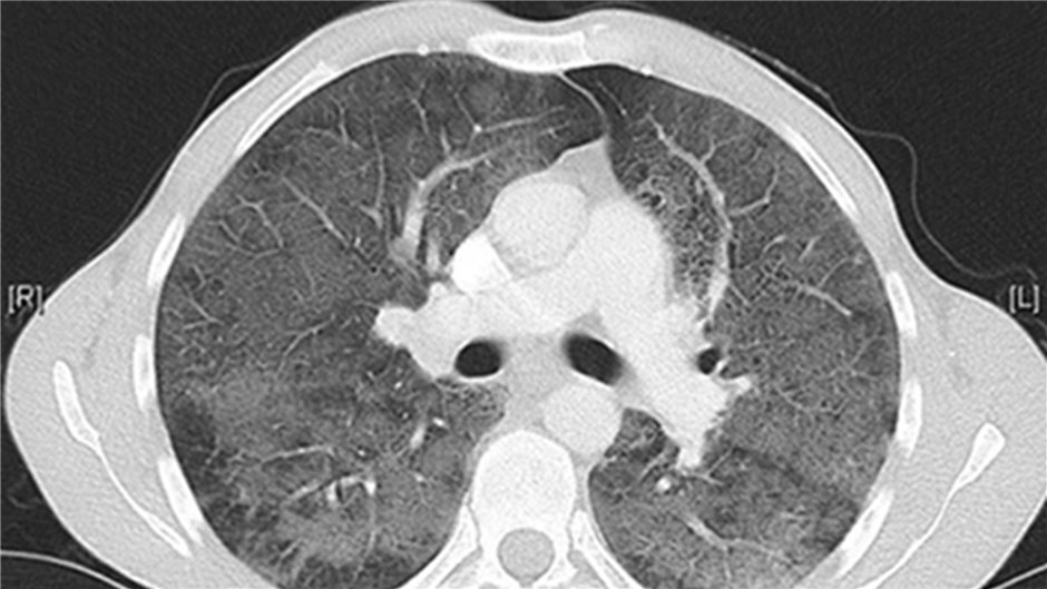  Opportunistische Infektionen bei HIV – Pneumocystis-jirovecii-Pneumonie
