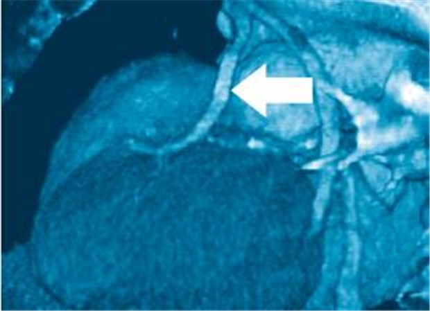 Koronarangioplastie - was wollen informierte Patienten? 3-D-Darstellung von Koronargefäßen nach einer Koronarangioplastie mit Stentimplantation (Pfeil).