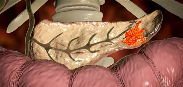3D-Darstellung eines Pankreaskarzinoms. Auch beim linksseitigen Karzinom muss die R0-Resektion das Ziel sein.