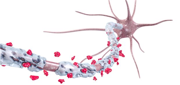 3D-Darstellung eines demyelinisierten Neurons bei Multipler Sklerose.