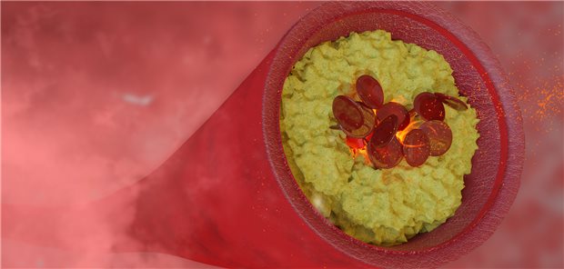 3D-Darstellung eines durch atherosklerotische Plaques nahezu komplett stenosierten Gefäßes.
