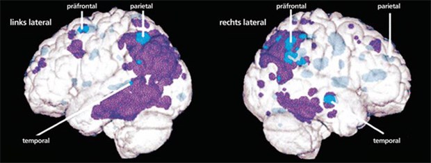 Antikörper löst Amyloid bei Alzheimer-Patienten 3D-Hirnmodelle. Der Stoffwechsel ist in den lila Arealen bei M. Alzheimer verringert. Daten von Patienten mit Alzheimer-Verdacht (blau) zeigen in ähnlichen Arealen eine Stoffwechselreduktion. © PNAS/Dr. Eric M. Reiman et. al.