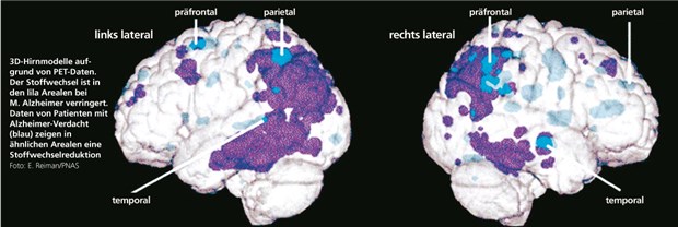 Blick ins Hirn lässt Ärzte oft ratlos 3D-Hirnmodelle aufgrund von PET-Daten. Der Stoffwechsel ist in den lila Arealen bei M. Alzheimer verringert. Daten von Patienten mit Alzheimer-Verdacht (blau) zeigen in ähnlichen Arealen eine Stoffwechselreduktion