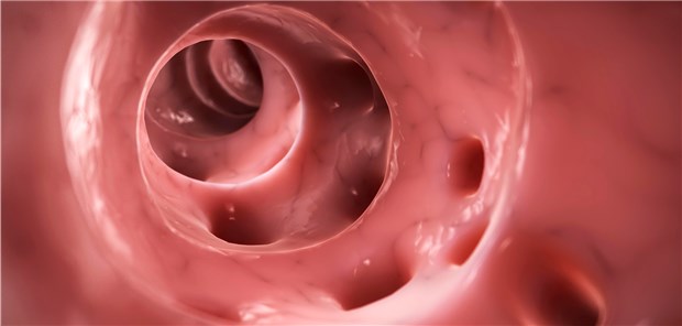 Antibiotikaverzicht bei unkomplizierter Divertikulitis ist sicher 3D-Illustration einer Divertikulitis.