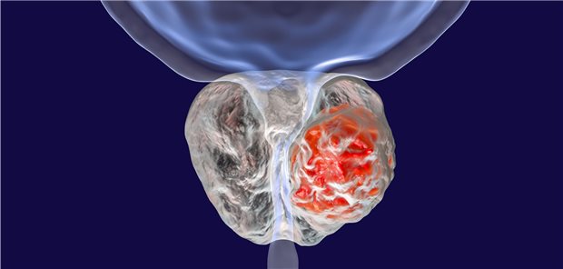 3D-Illustration eines Prostatakarzinoms. Neue Therapien verbessern die Prognose Betroffener.