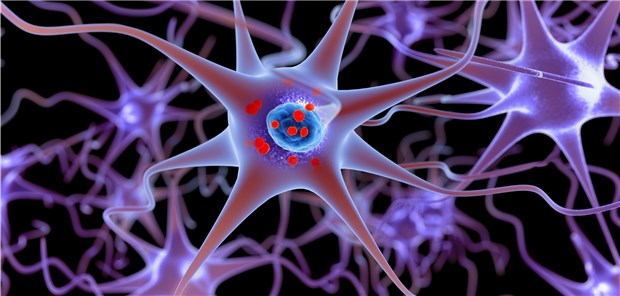 Blinddarmentfernung schützt offenbar vor Parkinson 3D-Illustration von Neuronen mit Lewy-Körperchen (rot), in denen sich Alpha-Synuclein-Proteine ansammeln.