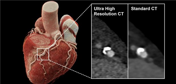 3D-Rekonstruktionen einer Computertomographie des Herzens mit Verkalkungen der linken Herzkranzarterie. Die innovative Photon-Counting-Detektor CT ermöglicht eine höhere räumliche Auflösung (UHR, links) im Vergleich zur herkömmlichen CT (Standard, rechts). Dadurch kann der Grad der Gefäßeinengung besser beurteilt werden.